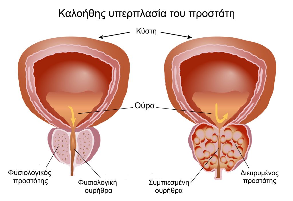 Καλοήθης υπερπλασία του προστάτη