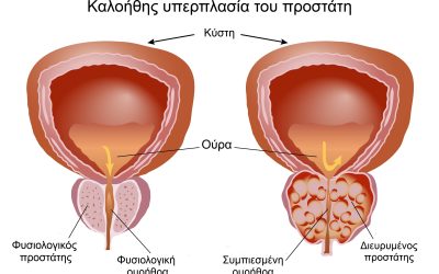 Καλοήθης Υπερπλασία Προστάτη – Συμπτώματα, Αιτίες, Διάγνωση & Οριστική Θεραπεία με HoLEP Laser